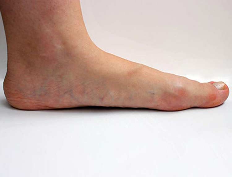 Flat feet