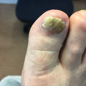 Fungal nail picture