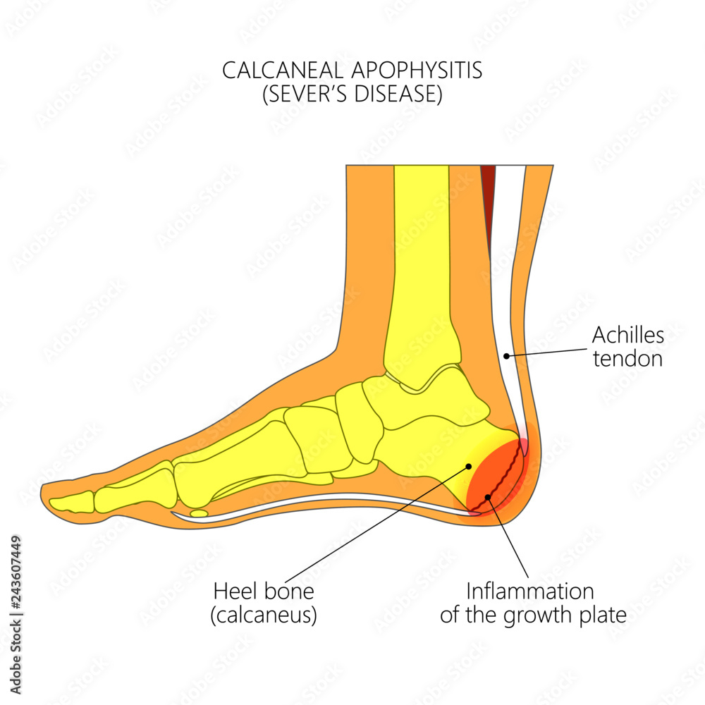 Heel Growth Plate
