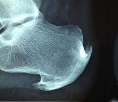 Heel Spur