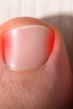 Ingrowing Toenails