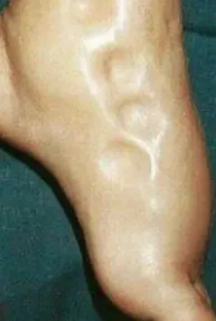 Pitting Oedema