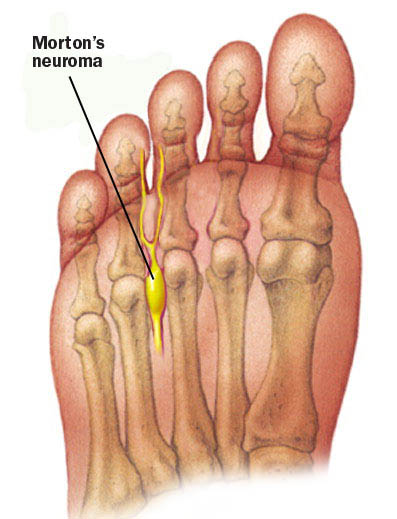 mortons neuroma