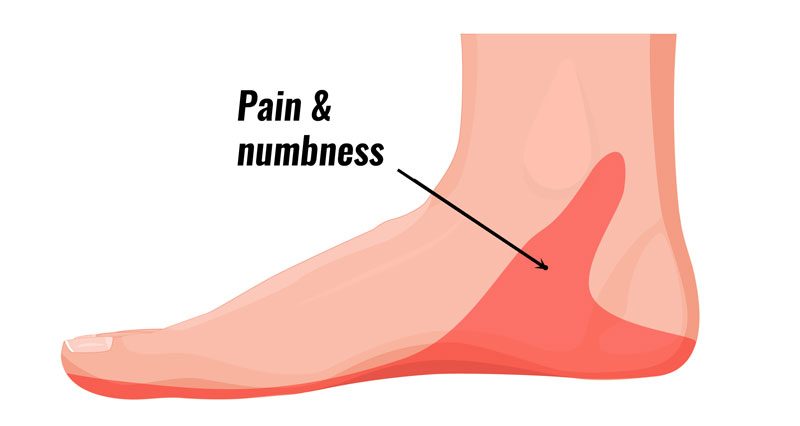 tarsal-tunnel-syndrome